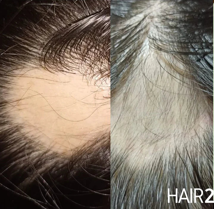 Locion Capilar + Shot de Crecimiento - Elimina la calvicie y control el crecimiento del cabello