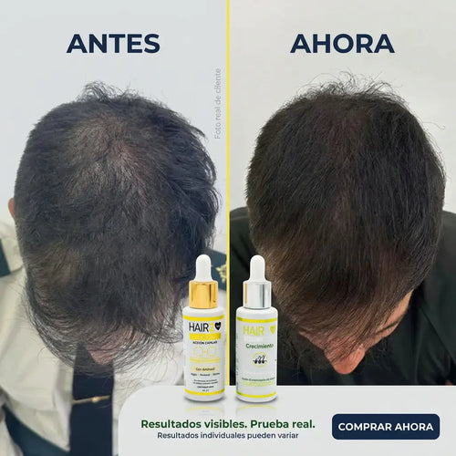 Locion Capilar + Shot de Crecimiento - Elimina la calvicie y control el crecimiento del cabello