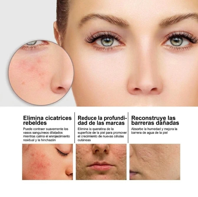 Sérum de nicotinamida para manchas Post-Acné